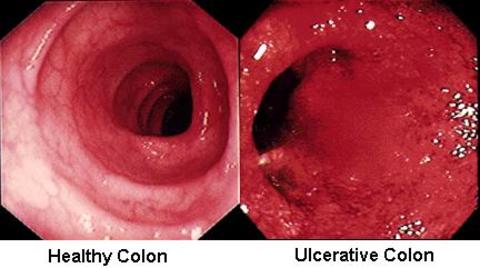 How To Protect Yourself From Inflammatory Bowel Diseases	