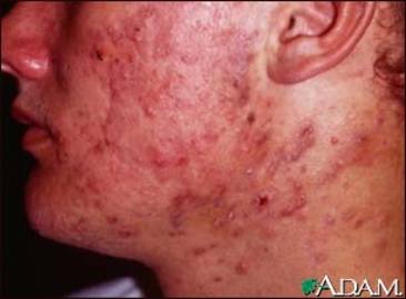 Where Can I Find Pictures Of Acne