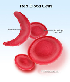 Stroke Treatment For Children With Sickle Cell Diseases 