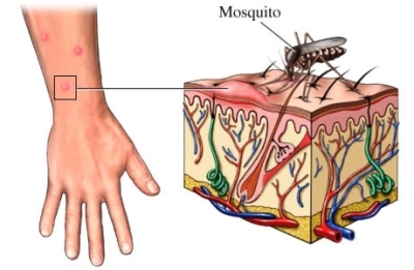 What Are The Symtoms And Treatment For Yellow Fever