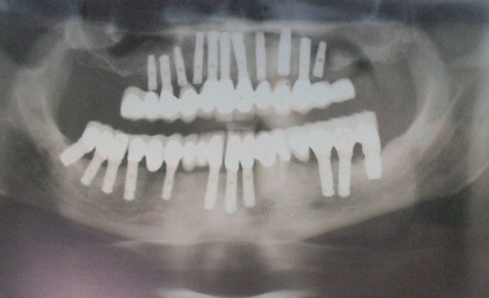 About the Chance Of Having Cancer After Having Dental X-Rays
