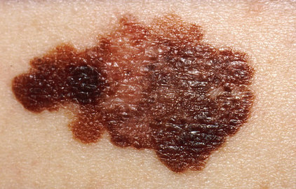 Brief overview of skin cancer diseases