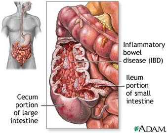 How To Diagnose Intestinal Diseases
