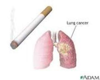 Symptoms And Treatment Of Small Cell Lung Cancer