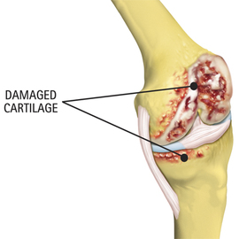 Information About Joint Diseases