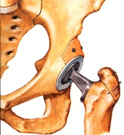 Will Medicare Pay For Replacement Hip Surgery