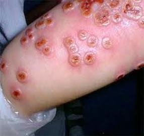 How To Treat Cowpox