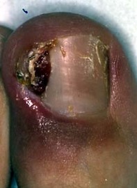 How To Prevent Nail Diseases Pictures	