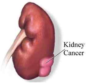 What Is Meant By the Term Stage 4 Cancer?