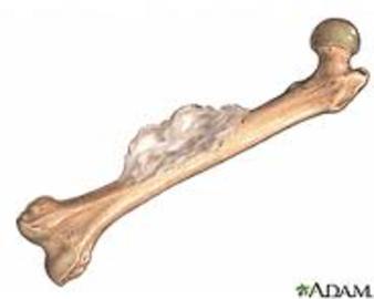 What Is Bone Cancer?
