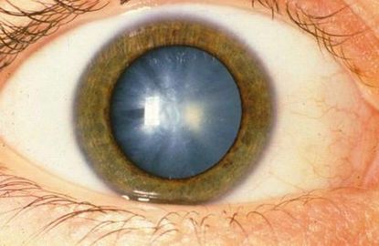 How To Treat Retinoblastoma