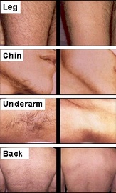 4 Reasons To Get Laser Hair Removal