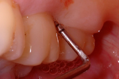 How To Diagnose Diseases Of the Gums