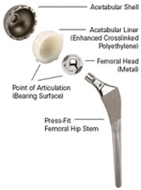 What Is Envolved in Surgery Hip Replacement