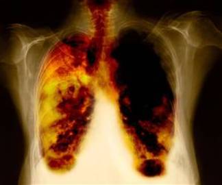 Rate Of Survial For Stage 4 Lung Cancer