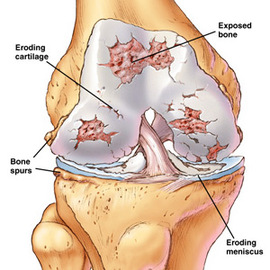 How To Treat Joint Diseases With Out Hospital 