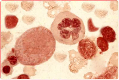 About Thalassemia Mediterranean Blood Disease