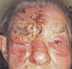 How To Deal With Shingles Diseases