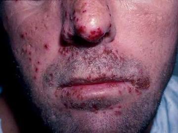 How to prevent herpes diseases