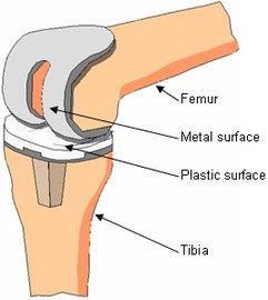 About Surgery For a Knee Replacement
