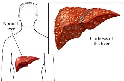 Liver Diseases Caused Due To Alcohol Consumption