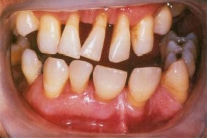 Are Periodontal Diseases Avoidable?