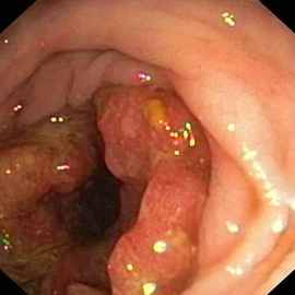 How Bad Is Cancer Colon Stage 4