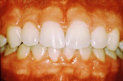 Are Periodontal Diseases Avoidable?
