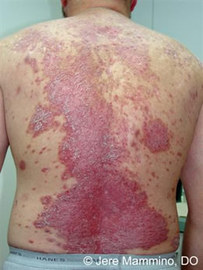 How To Prevent Psoriasis Skin Diseases	