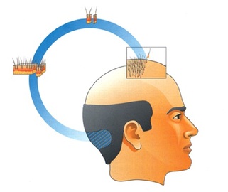The Process Of Hair Restoration