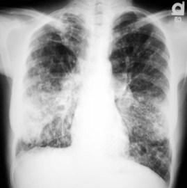 How To Prevent Pulmonary Diseases 