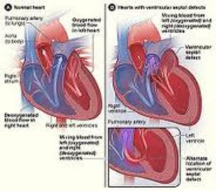 What you need to know about congenital heart diseases