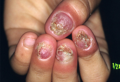 How To Prevent Nail Diseases Pictures	