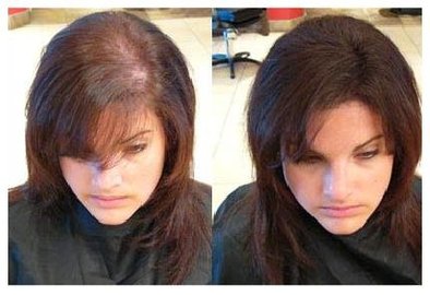 About Non Surgery Hair Replacement