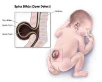 Spinal Diseases That Are Present At Birth