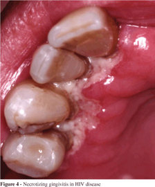 Oral Diseases That Are Preventable