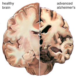 What Are The Causes And Treatment Of Alzheimer Diseases