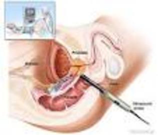 What Are Symptoms Of Prostate Cancer