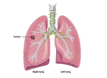 How Do I Determine Which Stage Lung Cancer I Have?