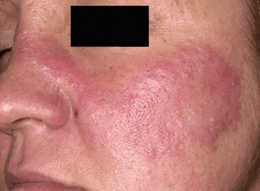 Skin Diseases - Pictures, Symptoms And Causes