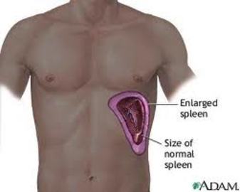  What You Must Know About Spleen Diseases 