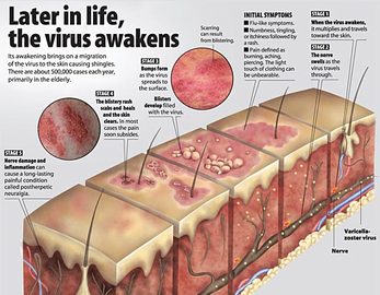  How To Protect Yourself From Shingles Diseases 