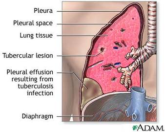 Are Pleural Diseases Fatal?