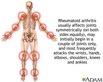 What Are The Causes Of Rheumatology Diseases	