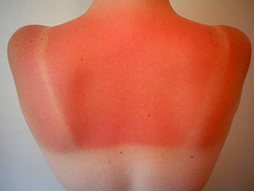 How To Prevent a Sunburn on Ghost White Skin