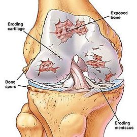 Most Common Hospital For Joint Diseases