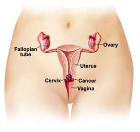 Common Signs Of Cervical Cancer