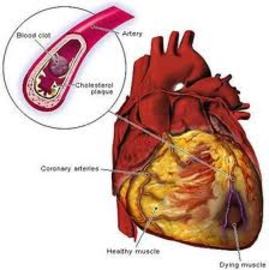 Most Common Cardiovascular System Diseases