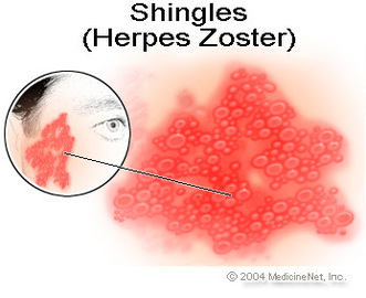 How To Deal With Shingles Diseases