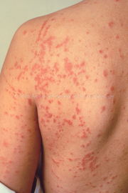  What Are The Causes Of   Allergic Diseases	